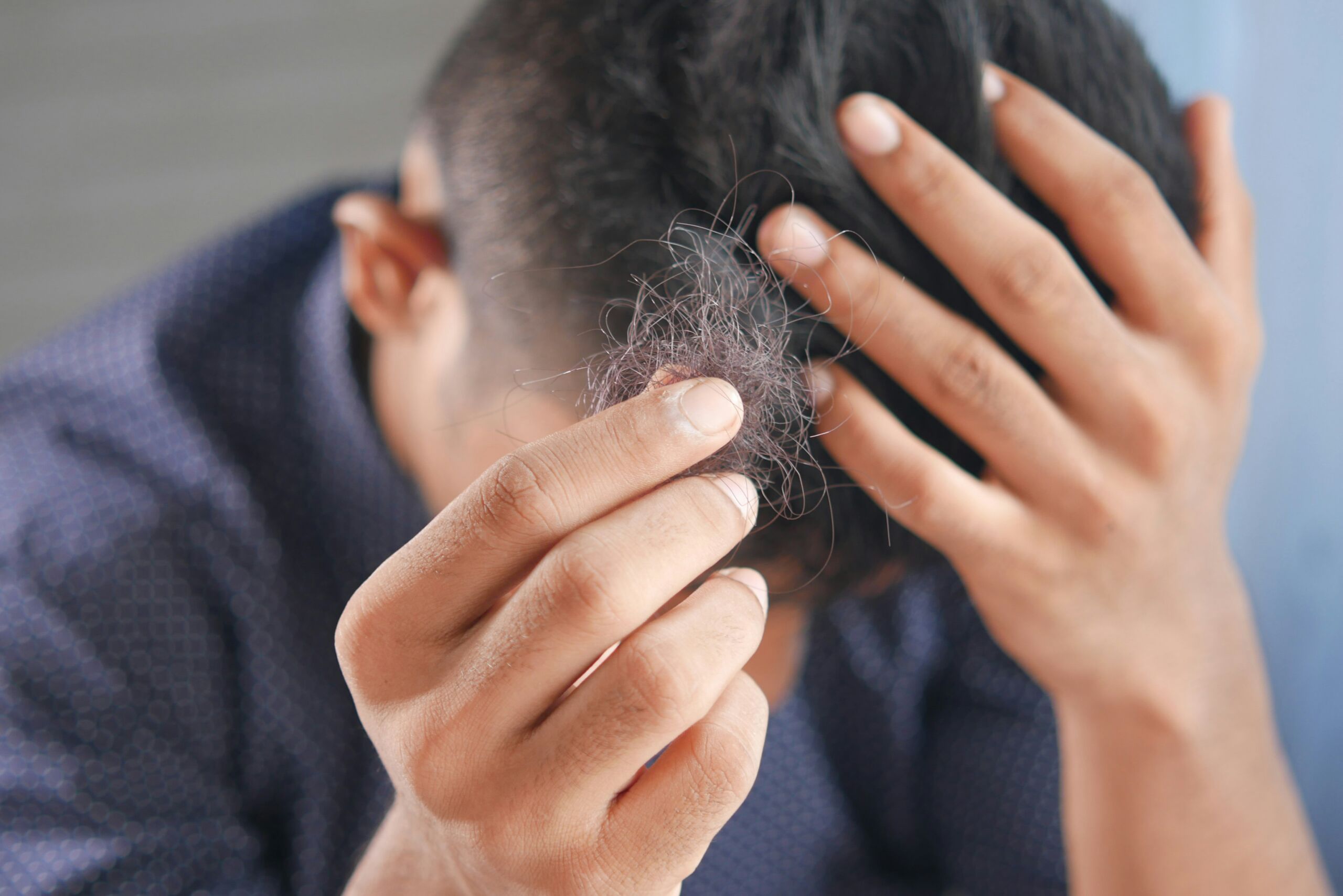 "rambut rontok usia muda penyebab", "kerontokan rambut remaja solusi",